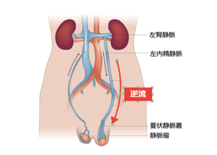 陰嚢が腫れる原因 | 中野駅前ごんどう泌尿器科