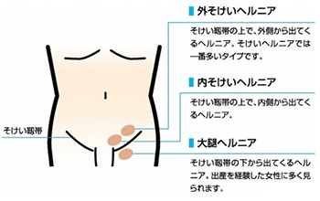 鼠径部の構造的な弱点 男性編｜鼠径ヘルニアの日帰り手術｜横浜青葉そけいヘルニア・外科クリニック