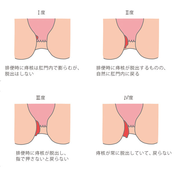 肛門周りの毛を処理するべき理由・処理方法と人気のOライン脱毛についても解説！ | メンズ脱毛百科事典 リンクスペディア