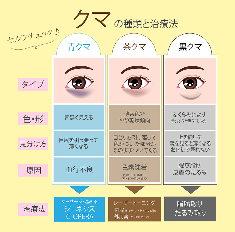 メイクをしても隠れない目の下のクマが改善！目の下のふくらみ取りの処置前と2週間後の症例です(20代女性) - 顔の脂肪吸引・糸リフト専門の美容整形クリニックA 