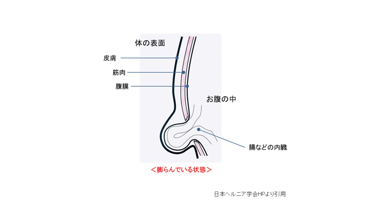 右鼠径部痛を主訴に来院した47歳男性［キーフレーズで読み解く 外来診断学（281）］｜Web医事新報|日本医事新報社