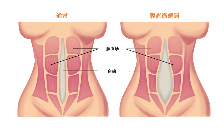 ヘルニアについて | 昭和藤が丘病院 消化器・一般外科 |