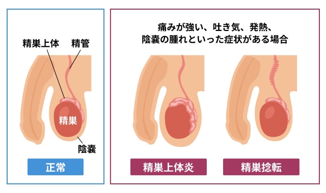 精巣上体炎の影響か、もしくは別の原因か」泌尿器科の相談。パセランさん（29歳/男性）の投稿。【CARADA 健康相談】  医師や専門家に相談できるQ&Aサイト。30万件以上のお悩みに回答