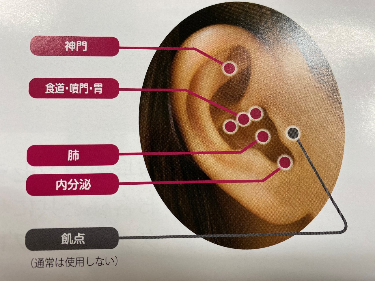 注意欠陥障害、注意欠陥多動性障害に対する耳つぼの治療