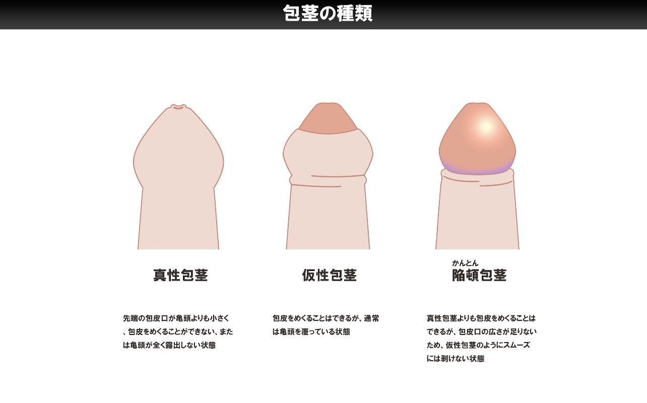 長茎手術に後悔しないポイントは？失敗のリスクと後遺症からクリニック選びのポイントを解説 | 包茎治療について｜おき泌尿器科クリニック｜富田林市の泌尿器科