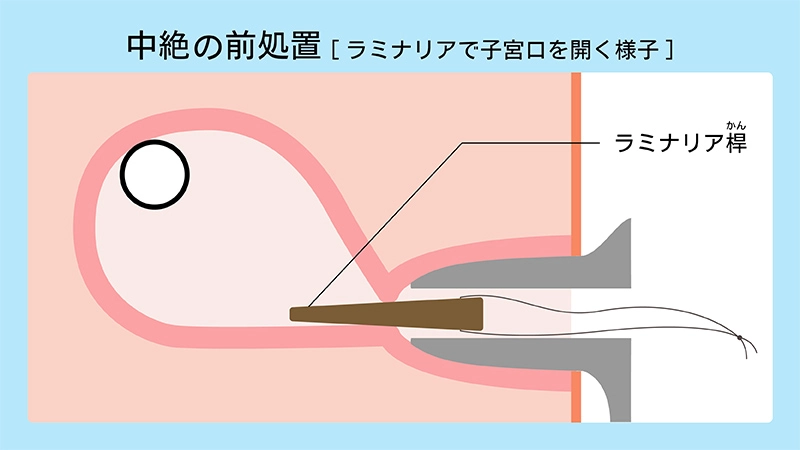 中絶手術・流産手術