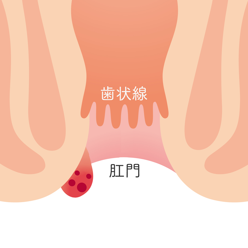 直腸の性病に感染しているとHIV感染リスクが高まる? | GME医学検査研究所