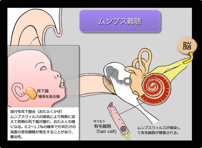 特発性両側性感音難聴の原因と治療法について | 大阪府豊中市細田耳鼻科