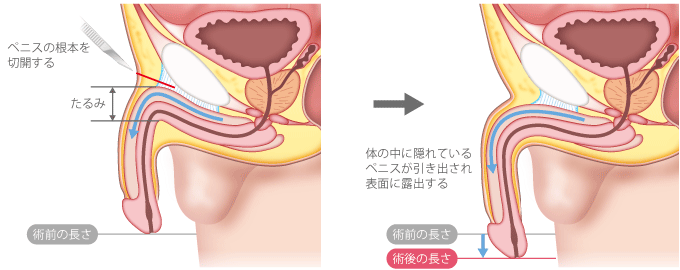 性器美白・Vホワイトニングレーザー｜黒ずみ・色素沈着を改善｜美容外科・美容皮膚科クリニーク福岡天神