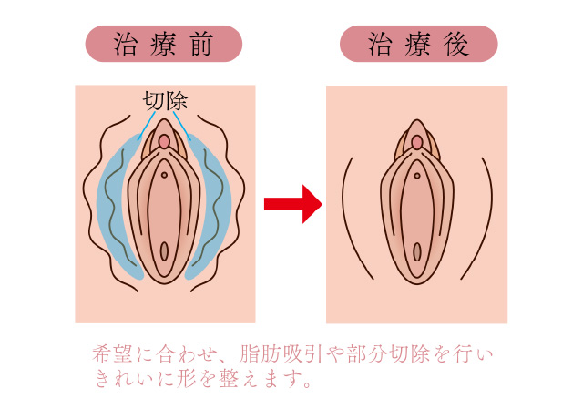 陰核包茎 | eクリニック大阪院【公式】｜美容整形・美容外科