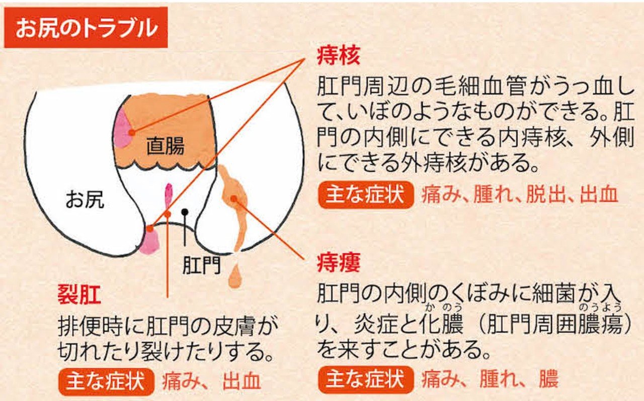 HIVの感染予防について｜HIV基礎知識｜北海道HIV/AIDS情報 北海道大学病院HIV診療支援センター