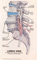 Slipping rib syndrome -