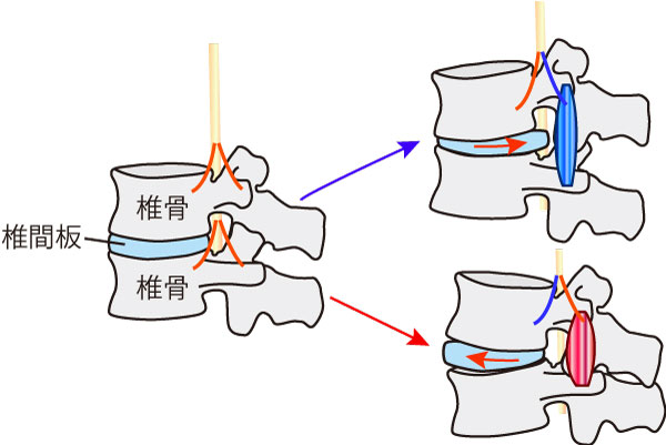 何度も繰り返すぎっくり腰・・・知らずに忍び寄る椎間板の変性が原因かも知れません。 |  腰や首、肩の違和感など、つらい痛みで悩んでいる方、オプティマルヘルスセンターへ