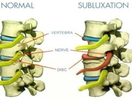 Subluxation（脊椎のズレ）とは？ - スポーツ選手もサポートし、症状・体質に応じて肩こりや腰痛改善。